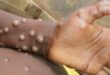Tot mai multe cazuri de variola maimuţei în Marea Britanie. Contacţii cu risc ridicat sunt sfătuiţi să se izoleze trei săptămâni